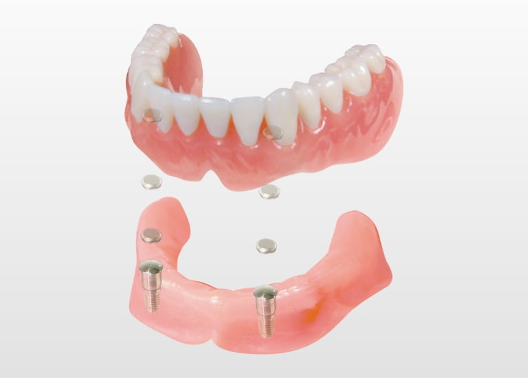 Dental magnetic attachment MAGFIT