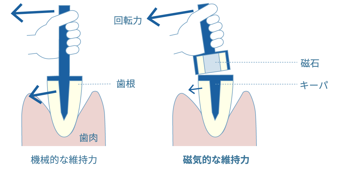 支台歯への負荷低減