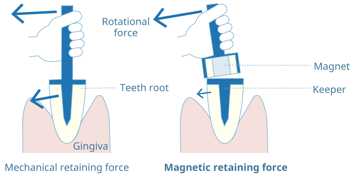 less stress for the abutment tooth