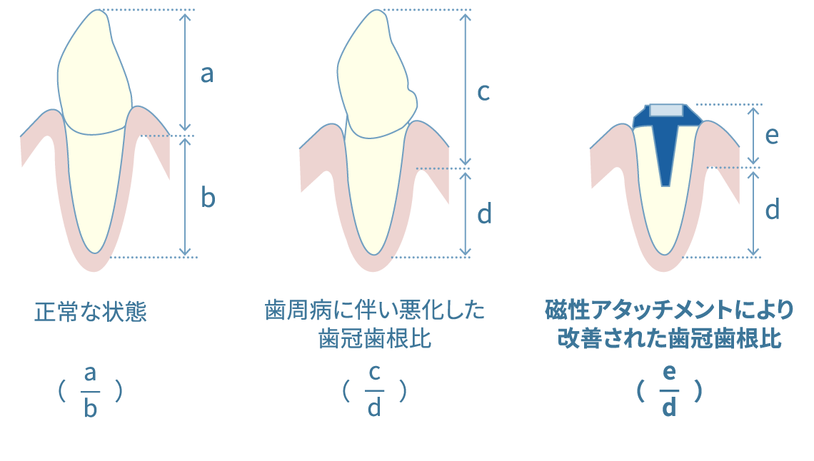支台歯の歯冠歯根比の改善