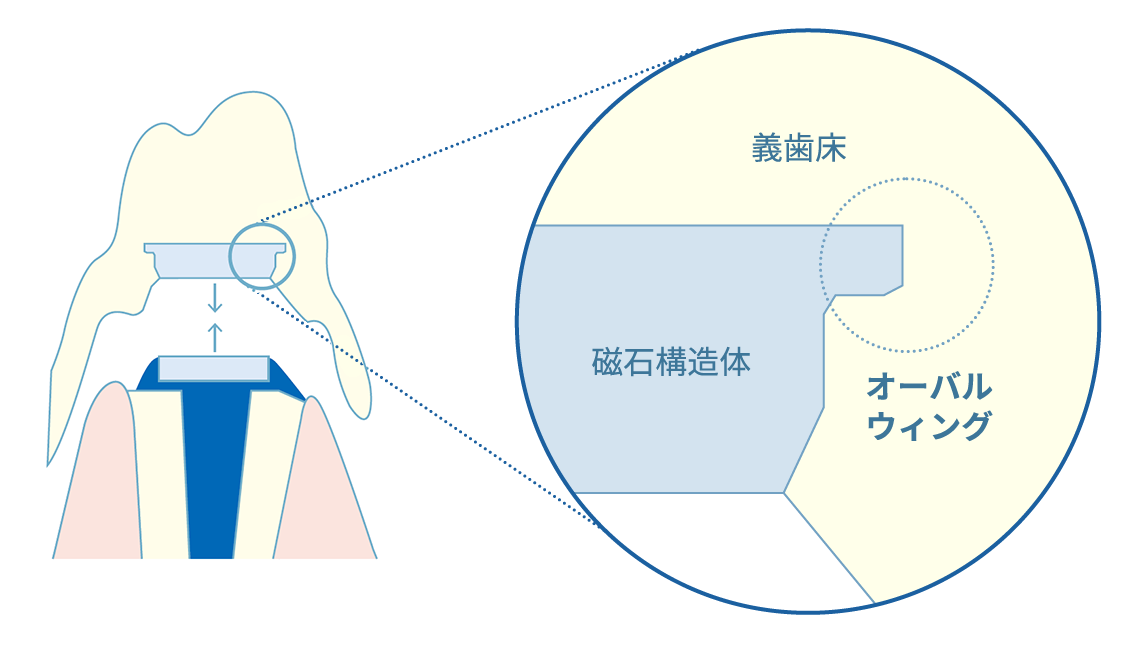 義歯からの脱落防止