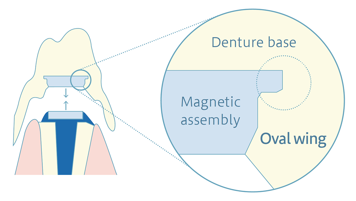 Preventing detachment from the denture