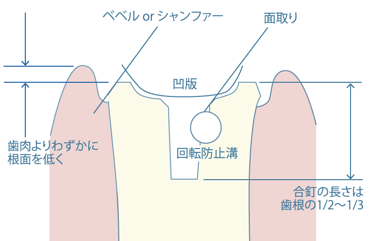 2. 支台歯形成