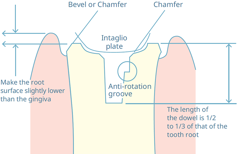 2. Preparation of the abutment tooth