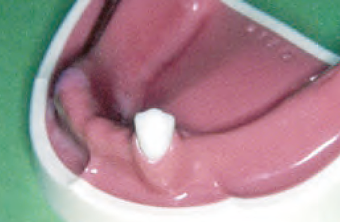 1.術前治療