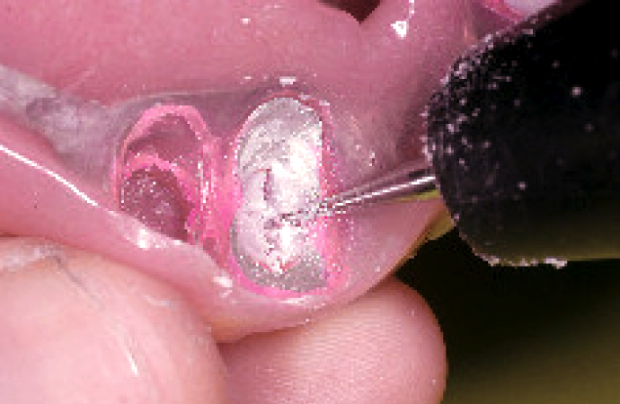 5.プラスチックダミーの除去