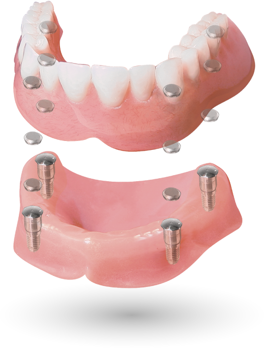 4 implant case