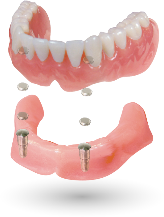 2 implant case